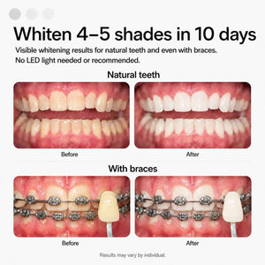 Opalescence Go 15- Prefilled Teeth Whitening Trays Kit - 15% Hydrogen Peroxide - (10 Treatments) Dentist Recomended - Made by Ultradent Products