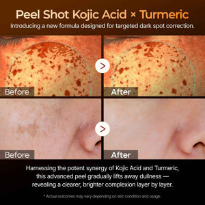 Dr. Melaxin Peel Shot Kojic Acid Turmeric Serum β Exfoliating Dark Spot Corrector with AHA/BHA & Niacinamide, Brightening & Even Tone