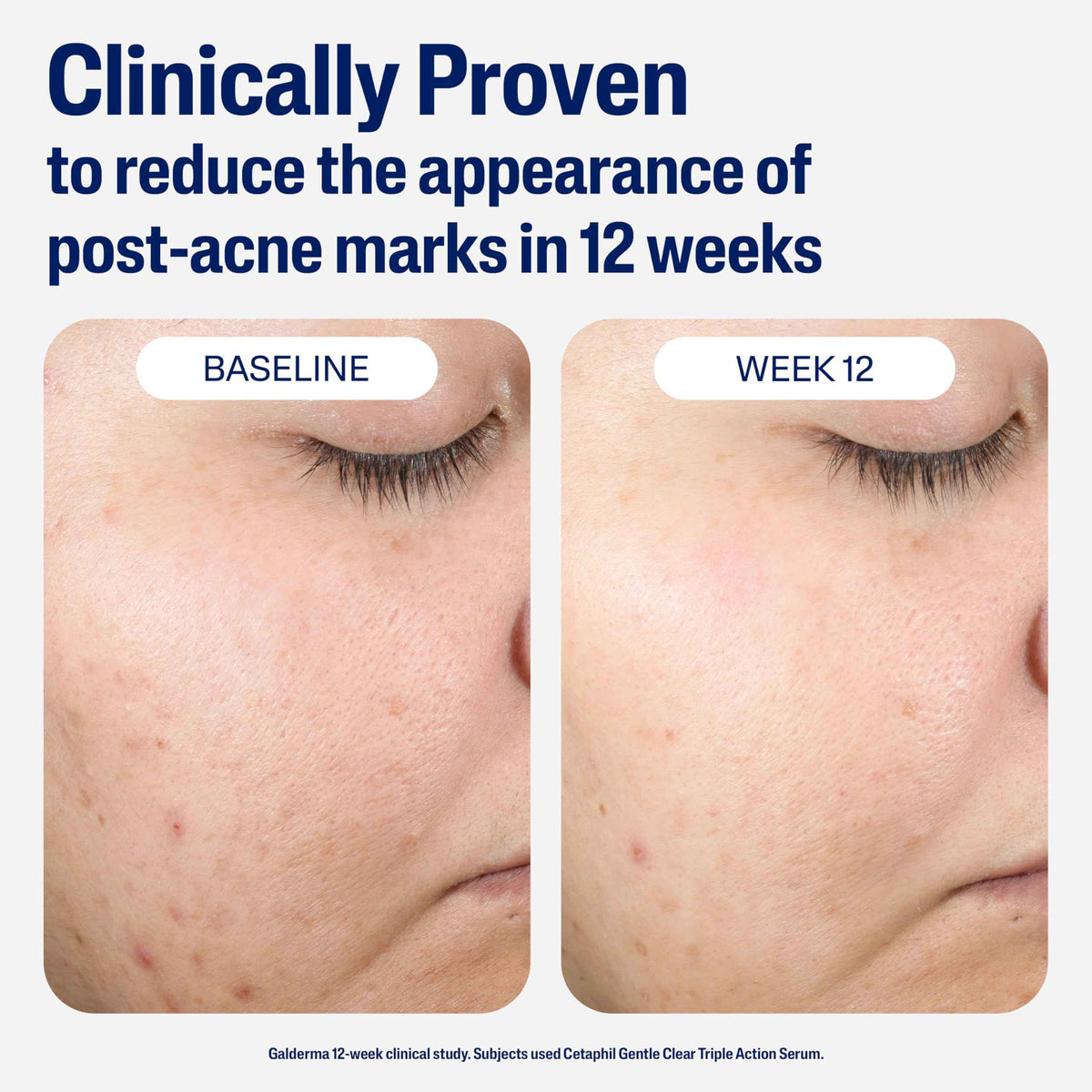 CETAPHIL Gentle Clear Repairing Post-Acne Serum, Retinol Alternative, Oil Free Serum for Sensitive Skin, 1 Fl Oz, Bakuchiol, Improves Skin Tone & Post-acne Marks,